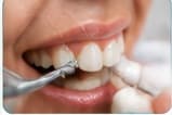Dental Cleaning