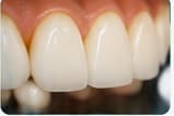 Dental Restoration